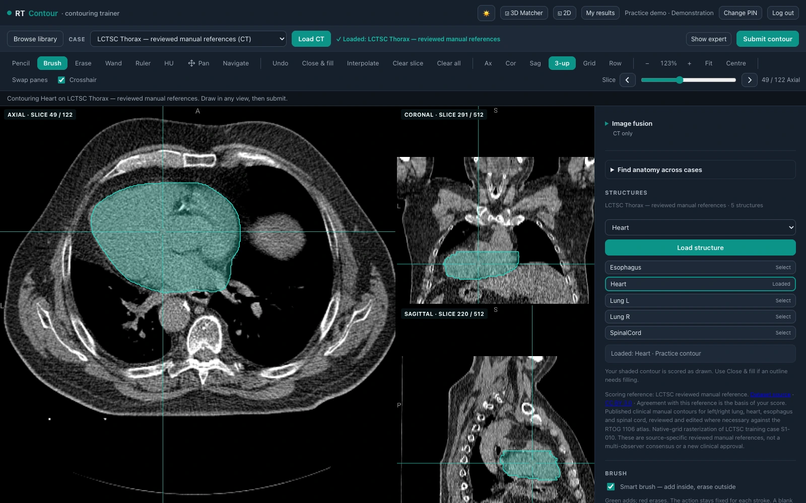 RT Contour workspace displaying real CT anatomy and a practice contour in linked scan views.