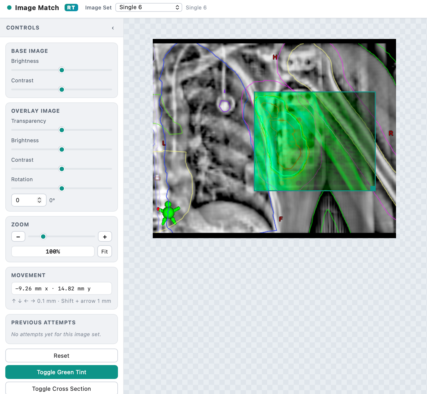2D planar image-matching trainer — reference and treatment overlay with alignment controls